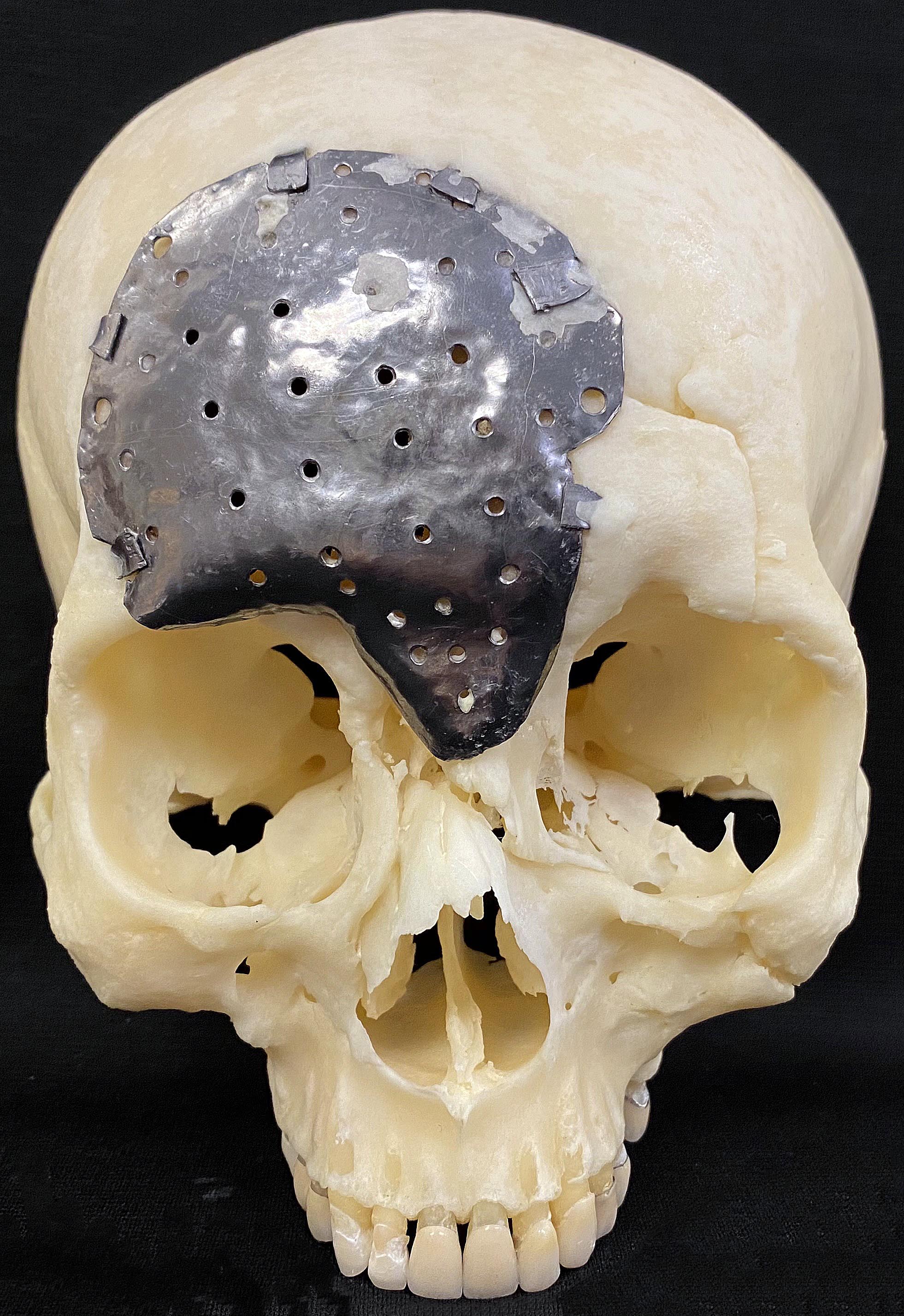 skeletal skull with metal implant