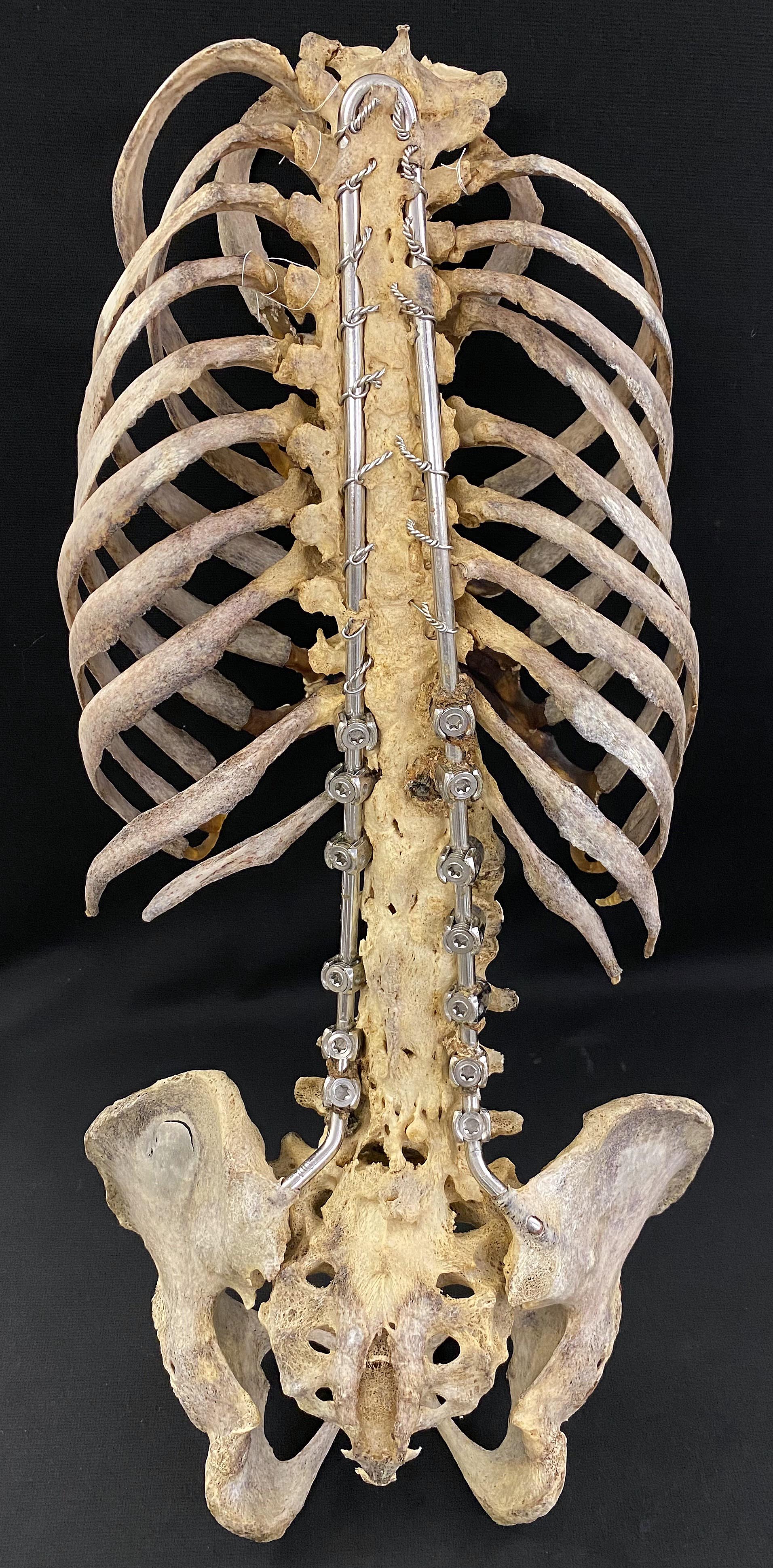skeletal spine with implants